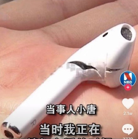 AirPods phát nổ trong khi đang gọi điện khiến người dùng phải nhập viện - Ảnh 1. AirPods phát nổ trong khi đang gọi điện khiến người dùng phải nhập viện - Ảnh 1.
