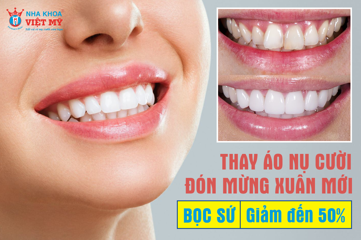 Chi tiết các chương trình khuyến mãi nha khoa hấp dẫn tại TP HCM - Ảnh 4. Chi tiết các chương trình khuyến mãi nha khoa hấp dẫn tại TP HCM - Ảnh 4.