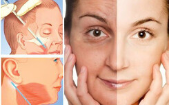 Giới chuyên môn nói gì về rủi ro khi căng da mặt?