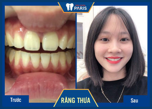 rang-thua-nen-nieng-hay-boc-su-de-co-nu-cuoi-rang-ro-hon-1 rang-thua-nen-nieng-hay-boc-su-de-co-nu-cuoi-rang-ro-hon-1