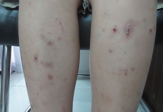 Những triệu chứng dễ nhận biết nhất khi bị nhiễm sán lợn - Ảnh 3. Những triệu chứng dễ nhận biết nhất khi bị nhiễm sán lợn - Ảnh 3.