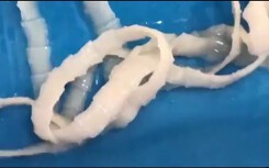 Quá trình bắt sán trưởng thành dài 5 m từ cơ thể cô gái trẻ