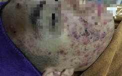 Mặt bị 'cày nát' vì tin quảng cáo lăn kim, thuốc bôi 'thần dược' tại cơ sở thẩm mĩ 'rởm'