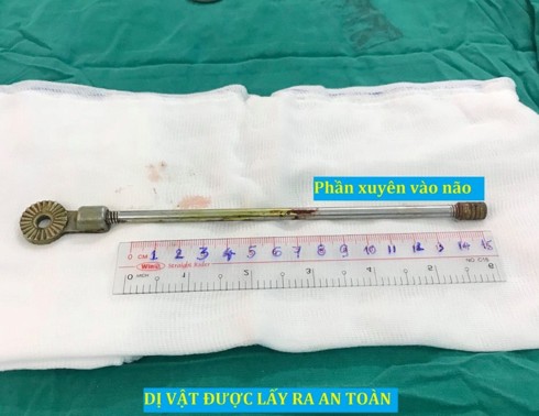 Bé trai 5 tuổi bị thanh sắt đâm xuyên qua hốc mắt vào não - Ảnh 2.