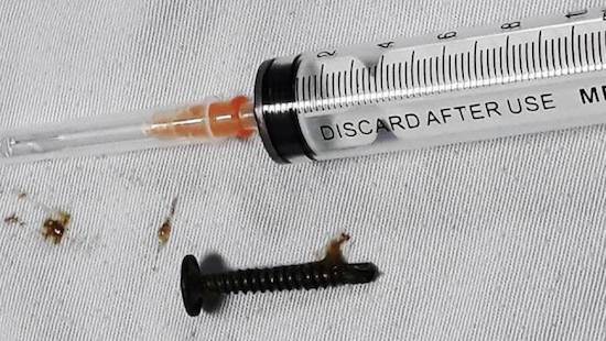 Bé 5 tuổi suýt thủng dạ dày vì nuốt đinh vít dài 3 cm - Ảnh 1.