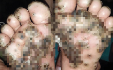 Chơi trong chuồng lợn không đi giày, bé gái 10 tuổi mắc bệnh lạ dưới bàn chân