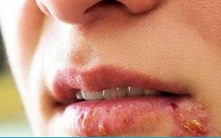 Không ngờ có người mắc bệnh lậu vì uống chung một chai bia