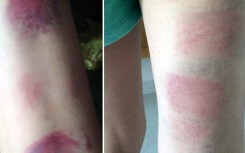 Làm rõ vụ cô giáo chủ nhiệm đánh 22 học sinh bầm tím