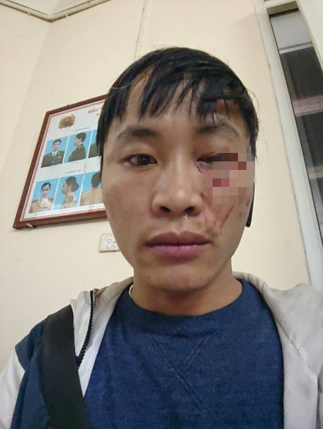 Người giao hàng bị khách đập điếu cày vào mặt vì phải chờ đợi - Ảnh 1. Người giao hàng bị khách đập điếu cày vào mặt vì phải chờ đợi - Ảnh 1.
