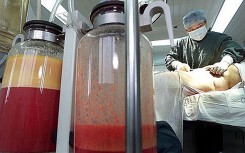 Những hình ảnh một ca hút mỡ bụng khiến người 'cứng vía' nhất cũng phải dựng tóc gáy