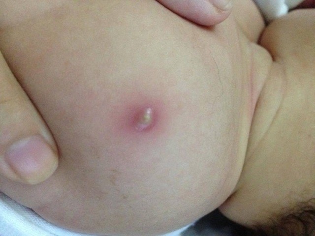 Vì sao trẻ sơ sinh phải tiêm phòng lao, trẻ bị mưng mủ sau tiêm phòng lao có đáng lo? - Ảnh 2.