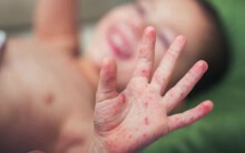 Thay vì ngồi nhà than thở lo con nhiễm bệnh, mẹ hãy đưa bé đi tiêm phòng sởi ngay đi