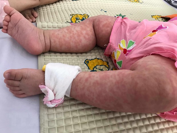 Thay vì ngồi nhà than thở lo con nhiễm bệnh, mẹ hãy đưa bé đi tiêm phòng sởi ngay đi - Ảnh 1.