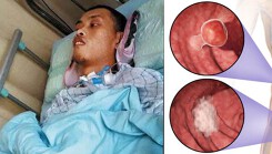 Bác sĩ 38 tuổi bị ung thư ruột giai đoạn cuối chỉ vì bỏ qua dấu hiệu này