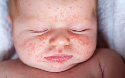 Mẹ nên biết: Không phải cứ muốn là bế con đi tiêm phòng sởi, đây mới là lúc tiêm vắc xin sởi chuẩn nhất