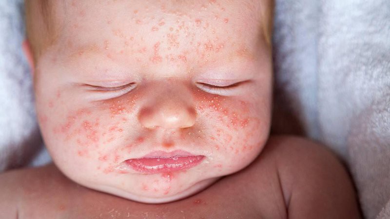 Mẹ nên biết: Không phải cứ muốn là bế con đi tiêm phòng sởi, đây mới là lúc tiêm vắc xin sởi chuẩn nhất - Ảnh 2.