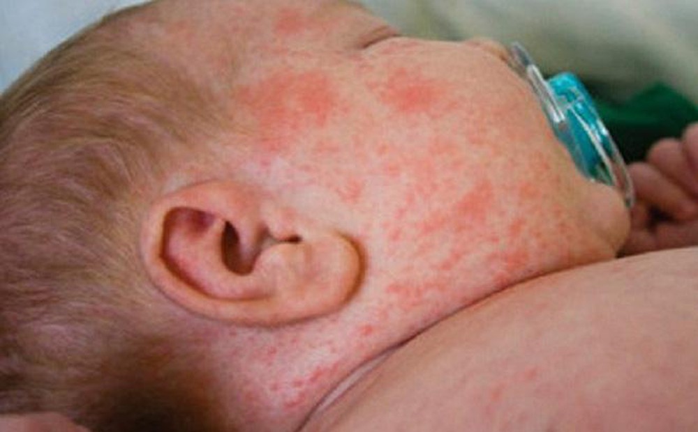 Mẹ nên biết: Không phải cứ muốn là bế con đi tiêm phòng sởi, đây mới là lúc tiêm vắc xin sởi chuẩn nhất - Ảnh 1.