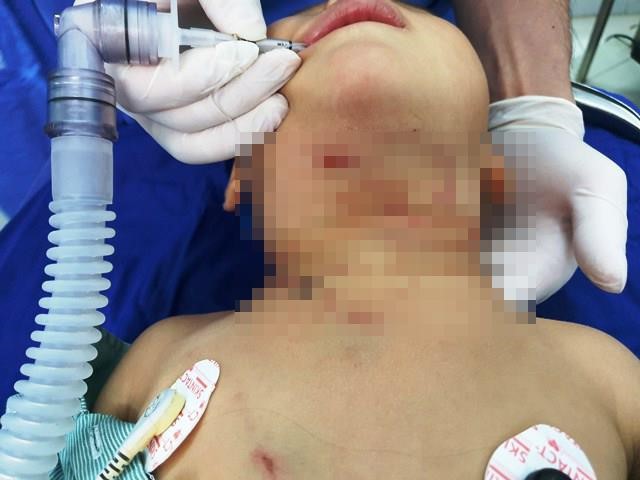 Sang hàng xóm bế nựng chó con, bé trai 3 tuổi bị chó mẹ tấn công cắn chảy máu cổ - Ảnh 1. Sang hàng xóm bế nựng chó con, bé trai 3 tuổi bị chó mẹ tấn công cắn chảy máu cổ - Ảnh 1.