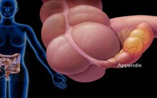 Đau ruột thừa là căn bệnh cấp tính, có thể đe dọa tính mạng
