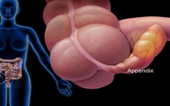 Đau ruột thừa là căn bệnh cấp tính, có thể đe dọa tính mạng