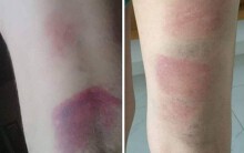 Lãnh đạo Sở GD&ĐT Bà Rịa - Vũng Tàu đến lớp xin lỗi sau vụ 22 học sinh bị cô giáo đánh bầm tím