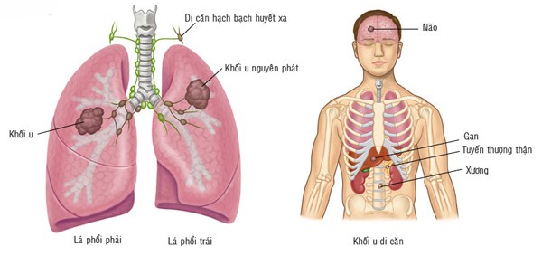 Loại quả rẻ nhất Việt Nam khiến tế bào ung thư không thể di căn - Ảnh 1. Loại quả rẻ nhất Việt Nam khiến tế bào ung thư không thể di căn - Ảnh 1.
