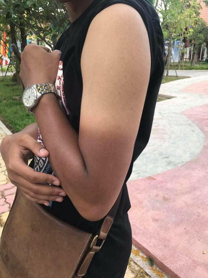 Muốn biết nắng nóng ở Sài Gòn gay gắt thế nào, cứ nhìn những hình xăm cháy nắng dưới đây là rõ - Ảnh 1. Muốn biết nắng nóng ở Sài Gòn gay gắt thế nào, cứ nhìn những hình xăm cháy nắng dưới đây là rõ - Ảnh 1.