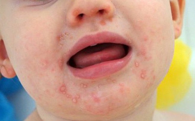Trời nắng nóng kéo dài, mẹ cần chú ý các bệnh mùa hè nguy hiểm để phòng bệnh cho con - Ảnh 5. Trời nắng nóng kéo dài, mẹ cần chú ý các bệnh mùa hè nguy hiểm để phòng bệnh cho con - Ảnh 5.