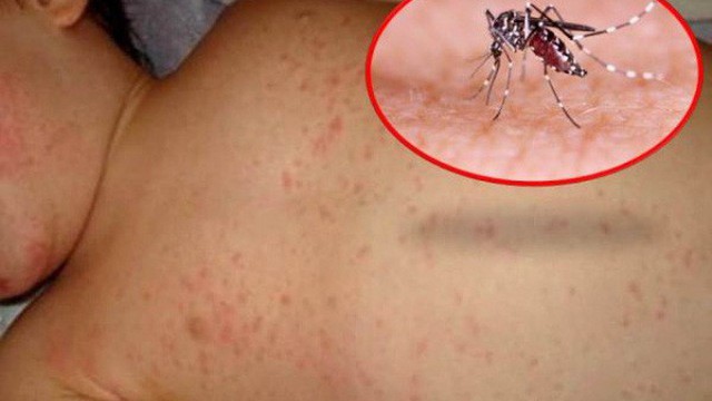 Trời nắng nóng kéo dài, mẹ cần chú ý các bệnh mùa hè nguy hiểm để phòng bệnh cho con - Ảnh 6. Trời nắng nóng kéo dài, mẹ cần chú ý các bệnh mùa hè nguy hiểm để phòng bệnh cho con - Ảnh 6.
