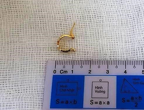 Bé gái 1 tuổi giật hoa tai bạn đang đeo nuốt vào bụng - Ảnh 1.