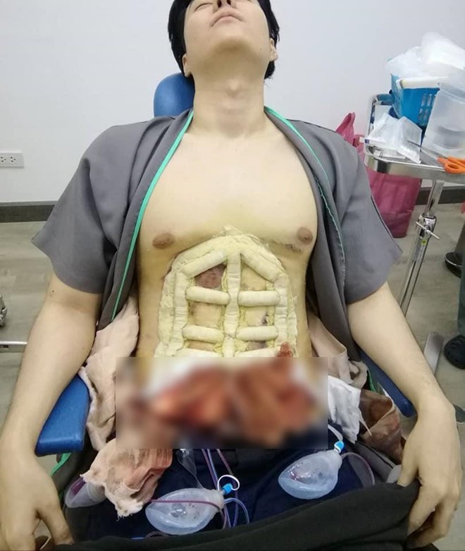Trào lưu phẫu thuật tạc cơ bụng giá 4000 USD: Con đường ngắn nhất để có 6 múi? - Ảnh 6.