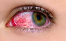 Virus đang hoành hành 'ngang ngược', dịch đau mắt đỏ có thể lây lan mạnh trong dịp nghỉ 30/4 - 1/5