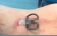 Cứu sống sản phụ tự đâm thấu tim vì trầm cảm