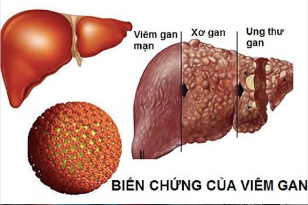 Viêm gan B lây lan nhanh hơn HIV gấp 100 lần, dùng chung bát đũa có lây?  - Ảnh 1.