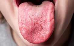 4 dấu hiệu ở lưỡi 'tố cáo' sức khỏe đang có vấn đề