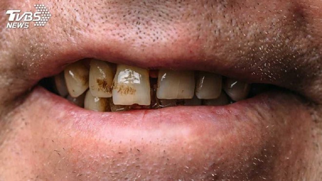 Thanh niên bị ung thư giai đoạn cuối vì ăn trầu và hút thuốc - Ảnh 1. Thanh niên bị ung thư giai đoạn cuối vì ăn trầu và hút thuốc - Ảnh 1.