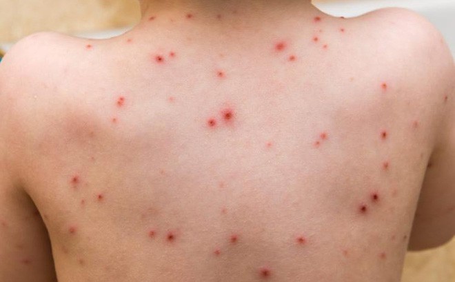 6 bệnh thường gặp vào trong những ngày nắng nóng, mọi người đều nên biết để phòng tránh - Ảnh 6. 6 bệnh thường gặp vào trong những ngày nắng nóng, mọi người đều nên biết để phòng tránh - Ảnh 6.