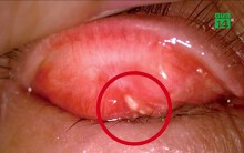 Chàng trai 26 tuổi có sỏi trong mắt vì thói quen về đêm