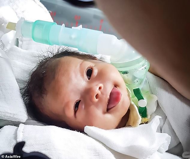 Khối u khổng lồ che lấp miệng một cô bé 9 tháng tuổi - Ảnh 2. Khối u khổng lồ che lấp miệng một cô bé 9 tháng tuổi - Ảnh 2.