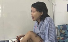Cô gái xinh đẹp bị chồng sắp cưới tạt axit: 'Tôi trắng tay rồi'