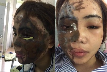 Từ vụ thiếu úy tạt axit vợ sắp cưới: Chuyên gia phân tích quá trình ăn mòn đốt cháy da thịt của axit - Ảnh 2. Từ vụ thiếu úy tạt axit vợ sắp cưới: Chuyên gia phân tích quá trình ăn mòn đốt cháy da thịt của axit - Ảnh 2.