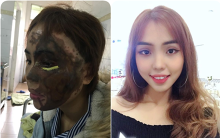 Từ vụ thiếu úy tạt axit vợ sắp cưới: Chuyên gia phân tích quá trình ăn mòn đốt cháy da thịt của axit