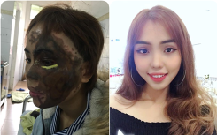 Từ vụ thiếu úy tạt axit vợ sắp cưới: Chuyên gia phân tích quá trình ăn mòn đốt cháy da thịt của axit