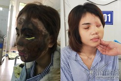 Bác sĩ kể lại hành trình hồi sinh gương mặt xinh đẹp cho cô gái bị thiếu úy tạt axit