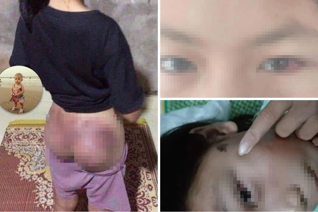 Nghi trộm tiền, bé gái ở Hà Tĩnh bị công an viên đánh bầm tím - Ảnh 1. Nghi trộm tiền, bé gái ở Hà Tĩnh bị công an viên đánh bầm tím - Ảnh 1.