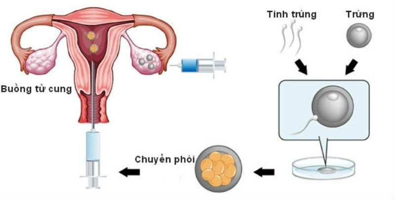 Thụ tinh ống nghiệm là gì, tại sao phương pháp này lại là cứu cánh cho các cặp vợ chồng vô sinh hiếm muộn - Ảnh 3. Thụ tinh ống nghiệm là gì, tại sao phương pháp này lại là cứu cánh cho các cặp vợ chồng vô sinh hiếm muộn - Ảnh 3.