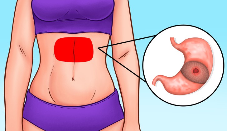 Các cơn đau nhói vùng bụng tố cáo sức khỏe bạn đang có vấn đề - Ảnh 3. Các cơn đau nhói vùng bụng tố cáo sức khỏe bạn đang có vấn đề - Ảnh 3.