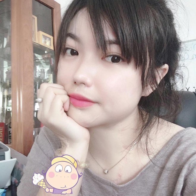 Cô gái xinh đẹp bị tạt axit và 20 lần phẫu thuật lấy lại diện mạo - Ảnh 3. Cô gái xinh đẹp bị tạt axit và 20 lần phẫu thuật lấy lại diện mạo - Ảnh 3.