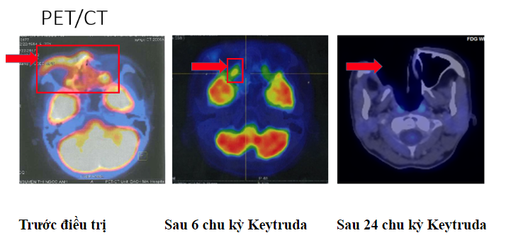 Keytruda_1 Keytruda_1