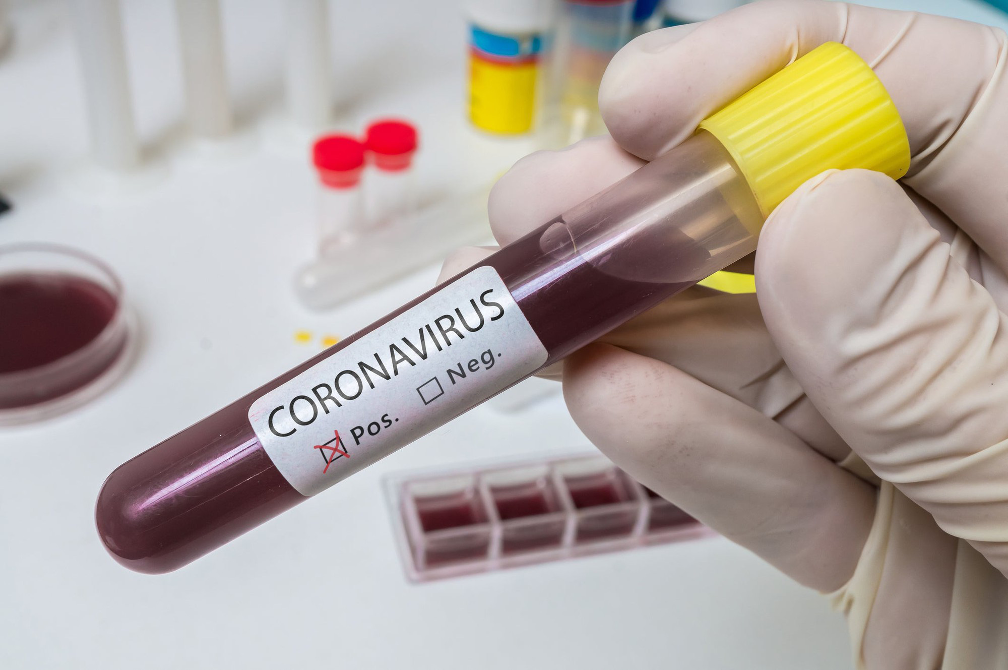 WHO: Ít nhất 20 loại vaccine ngừa COVID-19 đang chạy đua với thời gian để cứu người - Ảnh 2. WHO: Ít nhất 20 loại vaccine ngừa COVID-19 đang chạy đua với thời gian để cứu người - Ảnh 2.